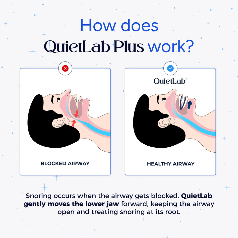 QuietLab Plus® Anti-Snoring Mouthpiece